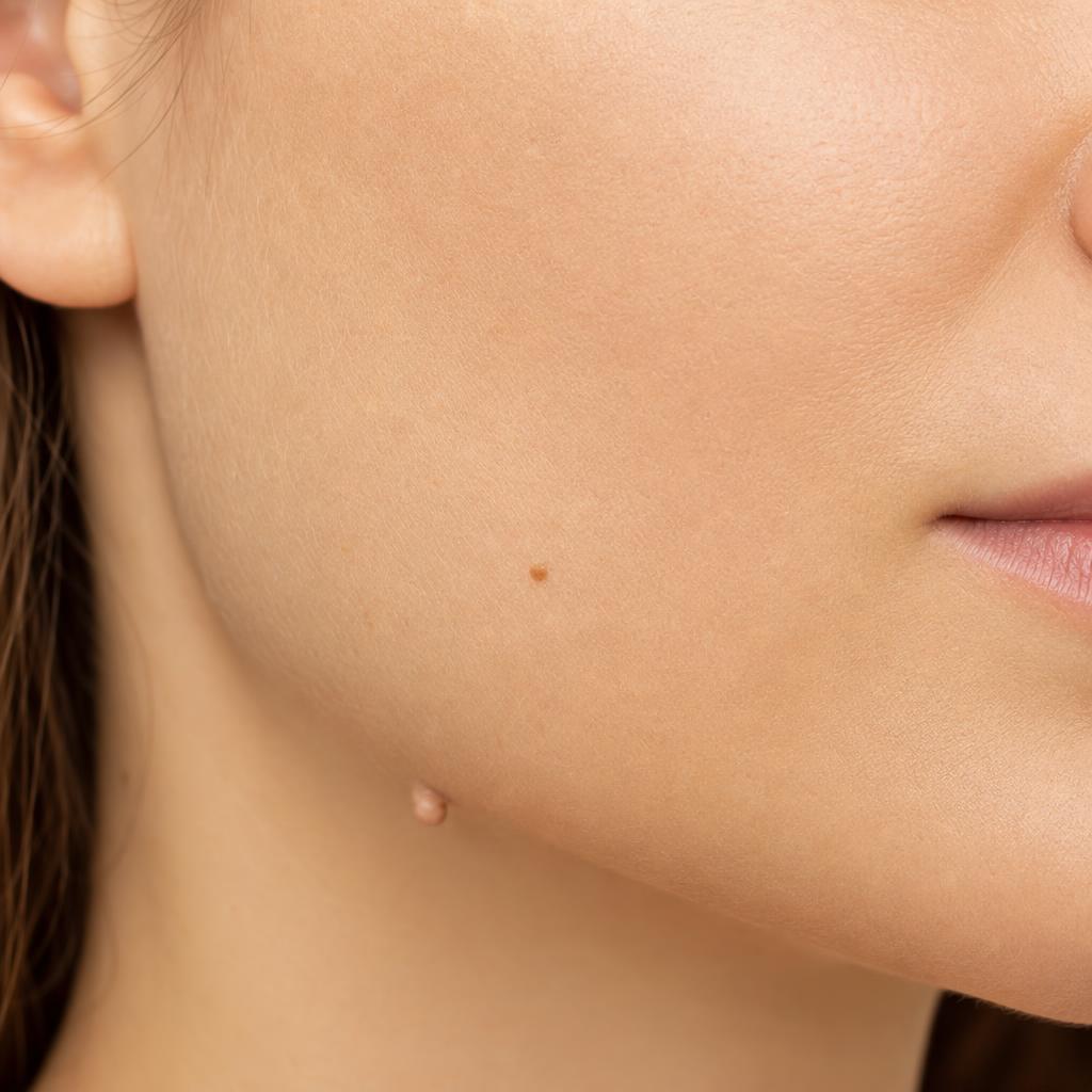 Skin Tag & Lesion Removal